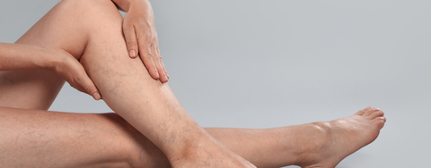 Varices – qu’est-ce que c’est, quelles sont leurs causes et comment peuvent-elles être atténuées ?